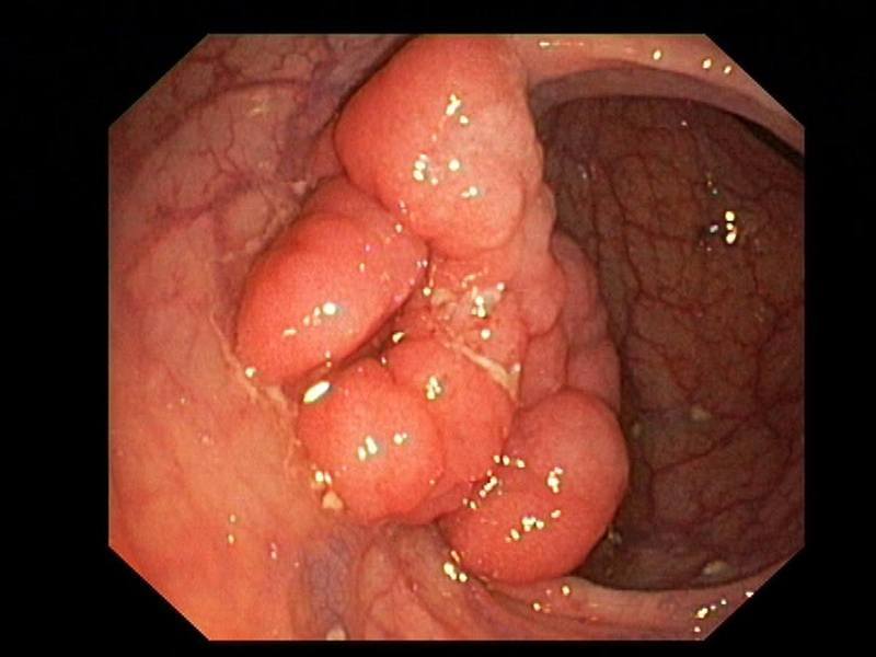 Cancer de colon