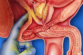 Tip list drcoloradocheckup prostata