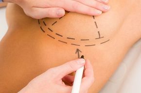 Tip list cirugia de busto
