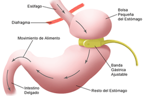 Tip list banda gastrica