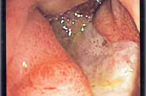Tip list gastritis