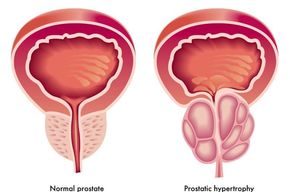 Tip list prostata