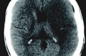 Tip list stroke
