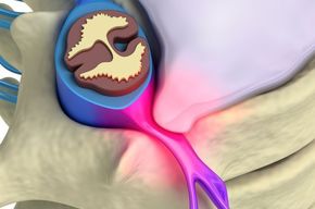 Tip list hernia de disco