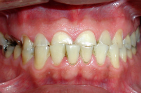 Tip list rehabilitaci n oral