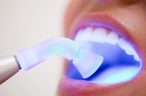 Tip list blanqueamiento dental
