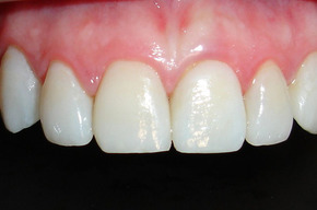 Tip list carrillas de porcelana