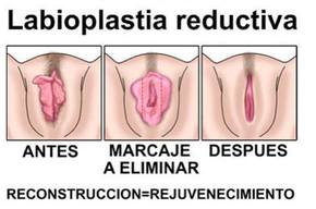 Tip list labioplastia