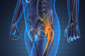 Tip list fractura de cadera