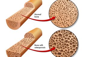 Tip list 123 osteoporosis