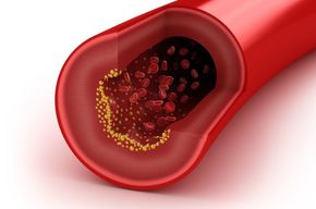 Tip list 123 arterosclerosis