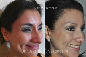 Tip list botox azeneth