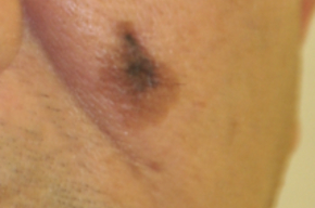 Tip list lentigo maligno melanom a