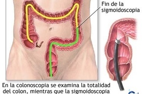 Tip list colonoscopia